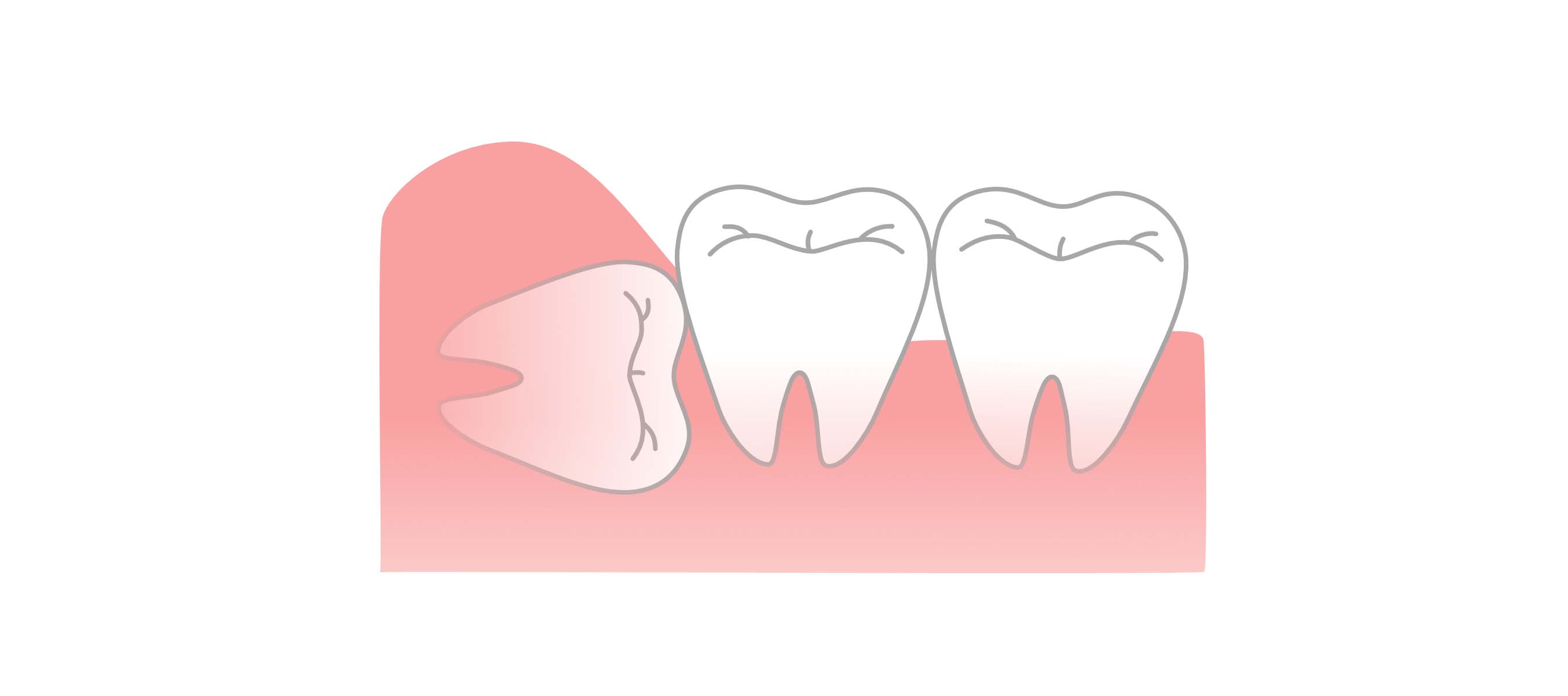 横向きや埋没にも対応！当院の親知らずの抜歯について
