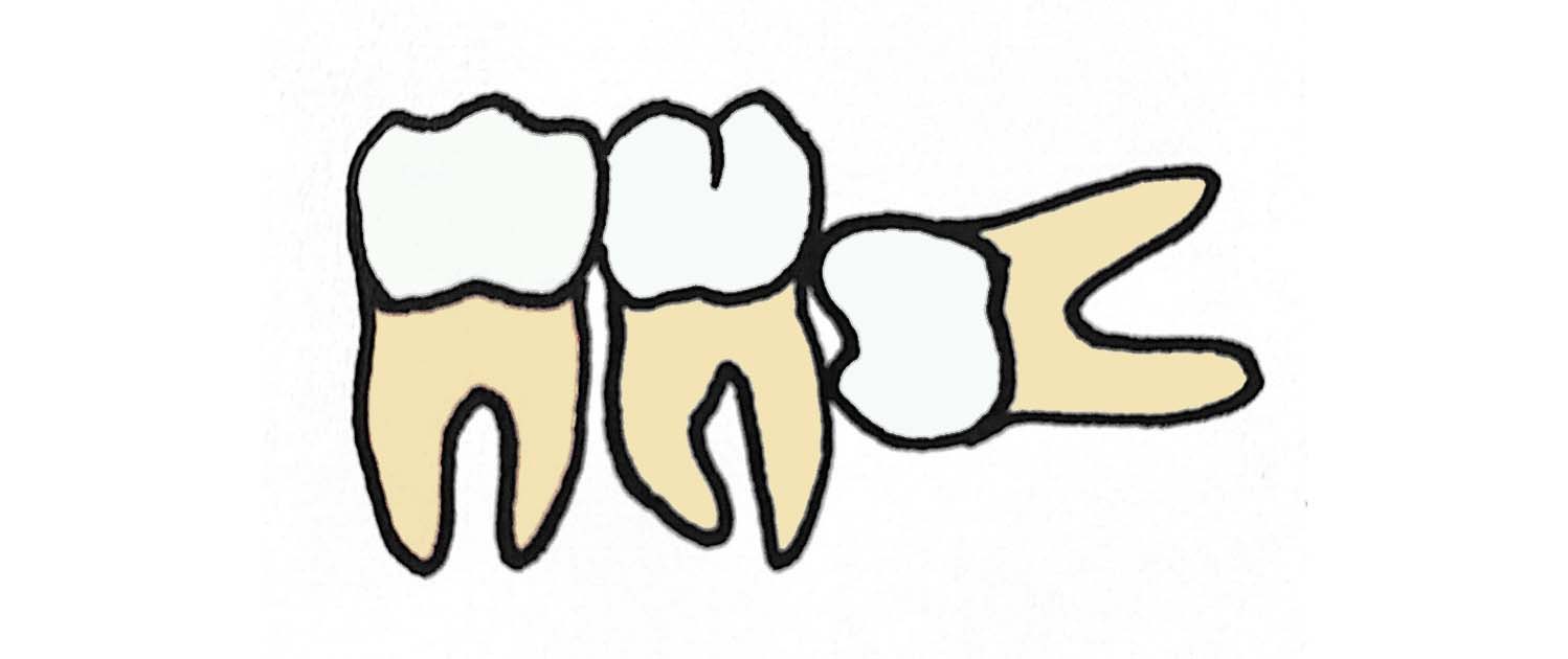 横向きや埋没にも対応！当院の親知らずの抜歯について