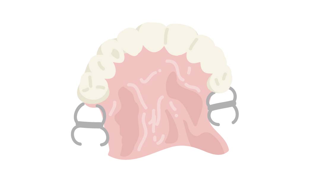 部分入れ歯