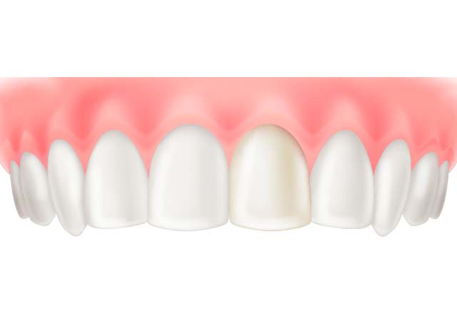 コンポジットレジン