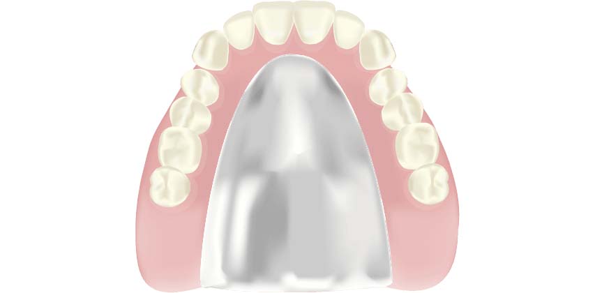 コバルトクロム床義歯