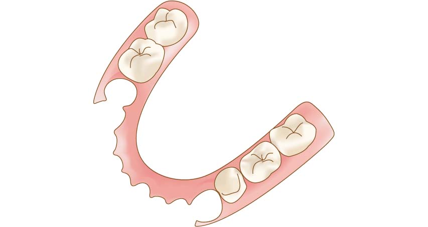 ノンクラスプデンチャー