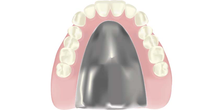 チタン床義歯
