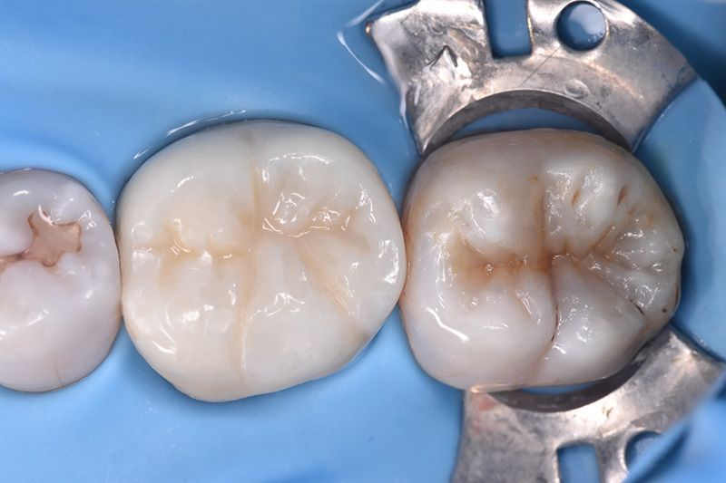 ダイレクトボンディング法