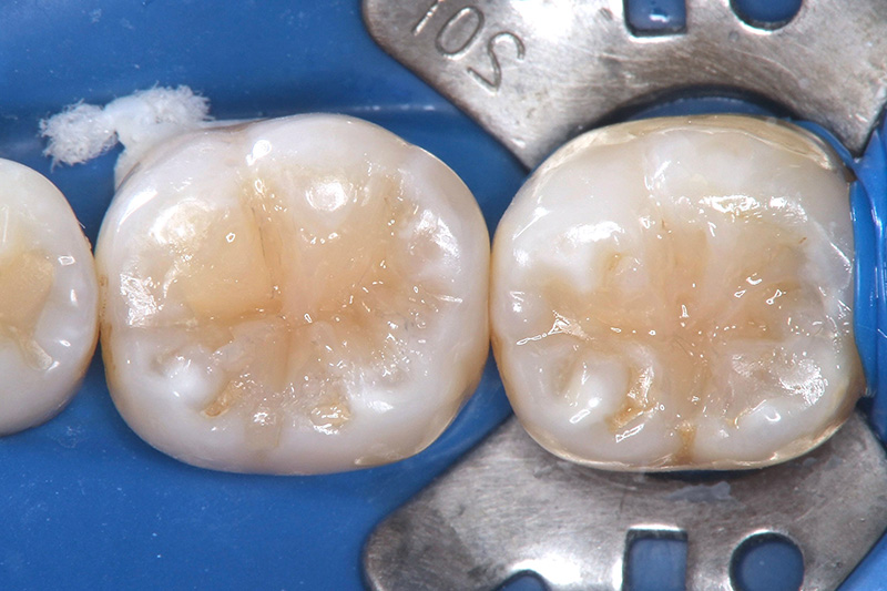 形態の修正と研磨