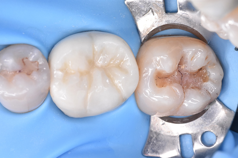 ダイレクトボンディング法