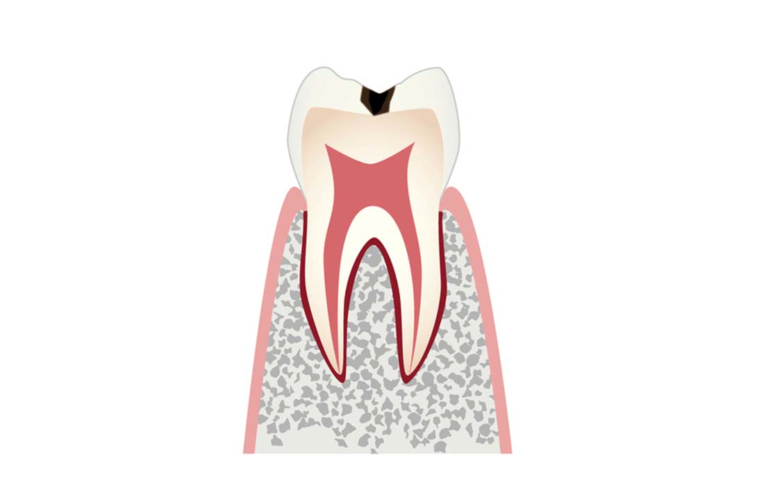 初期のむし歯（C0〜C1）