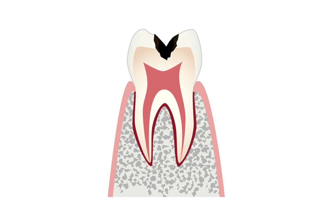 歯の内部まで進行したむし歯（C2）