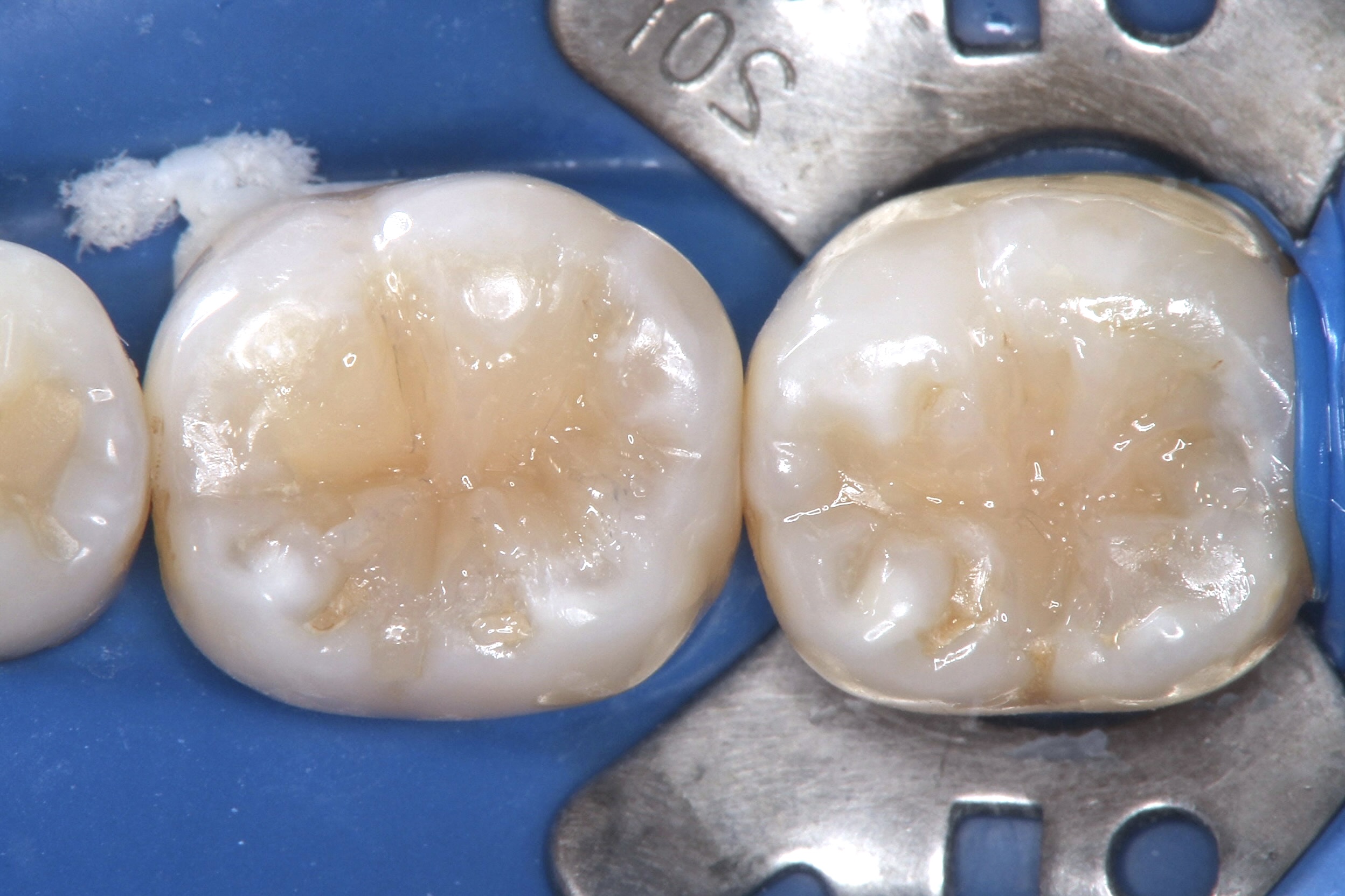 ダイレクトボンディング法