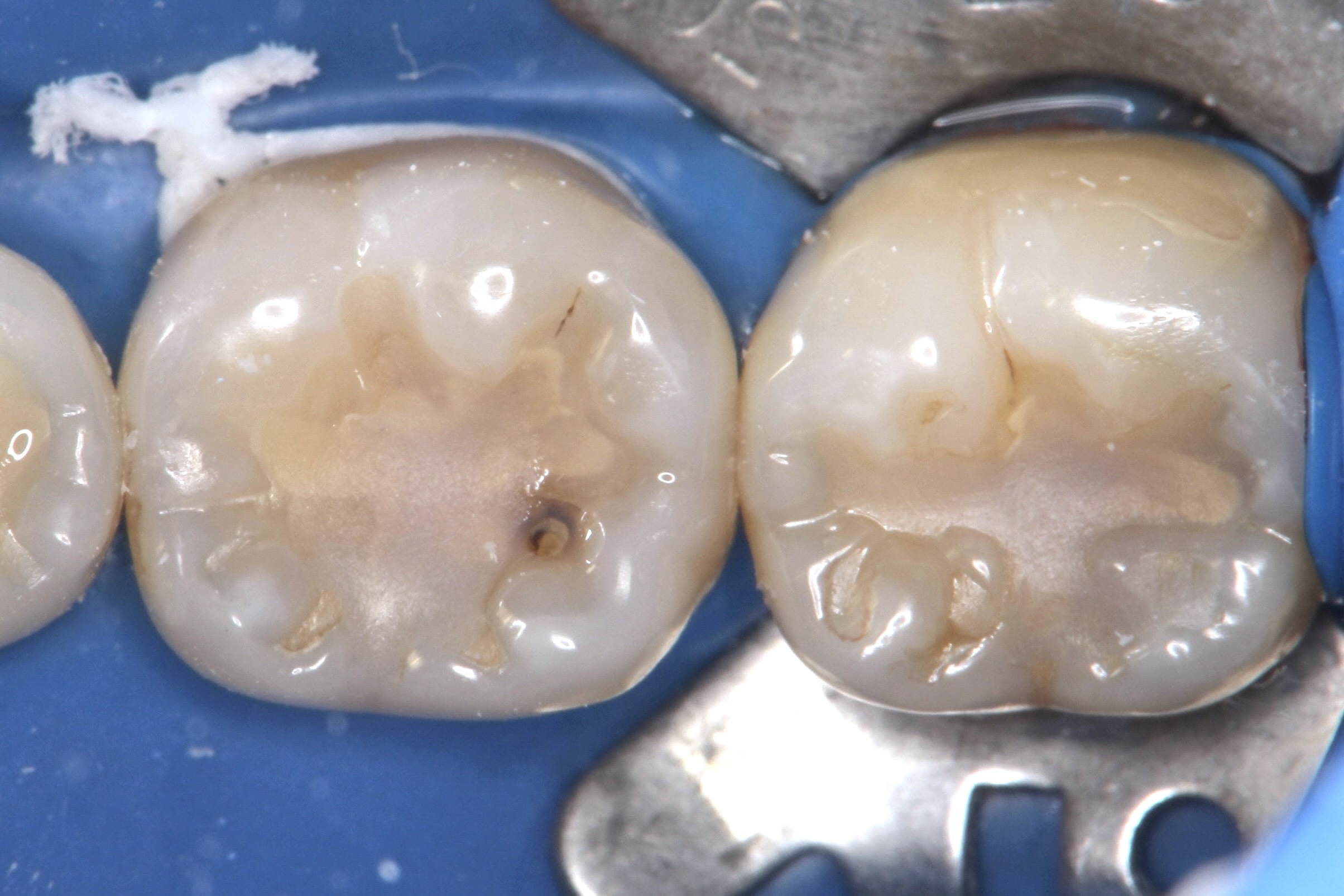 ダイレクトボンディング法