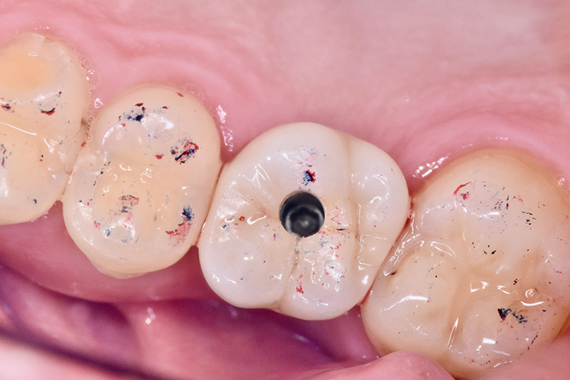 上部構造の装着