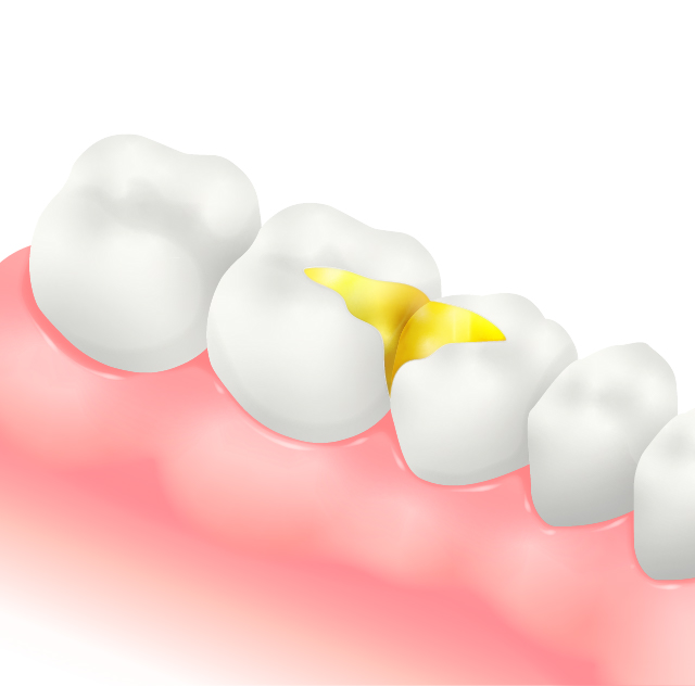 ゴールドインレー／ゴールドクラウン