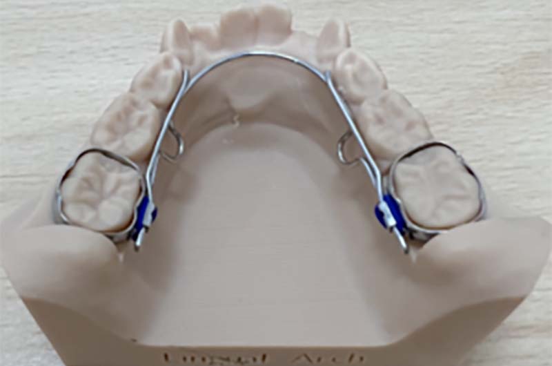 リンガルアーチ