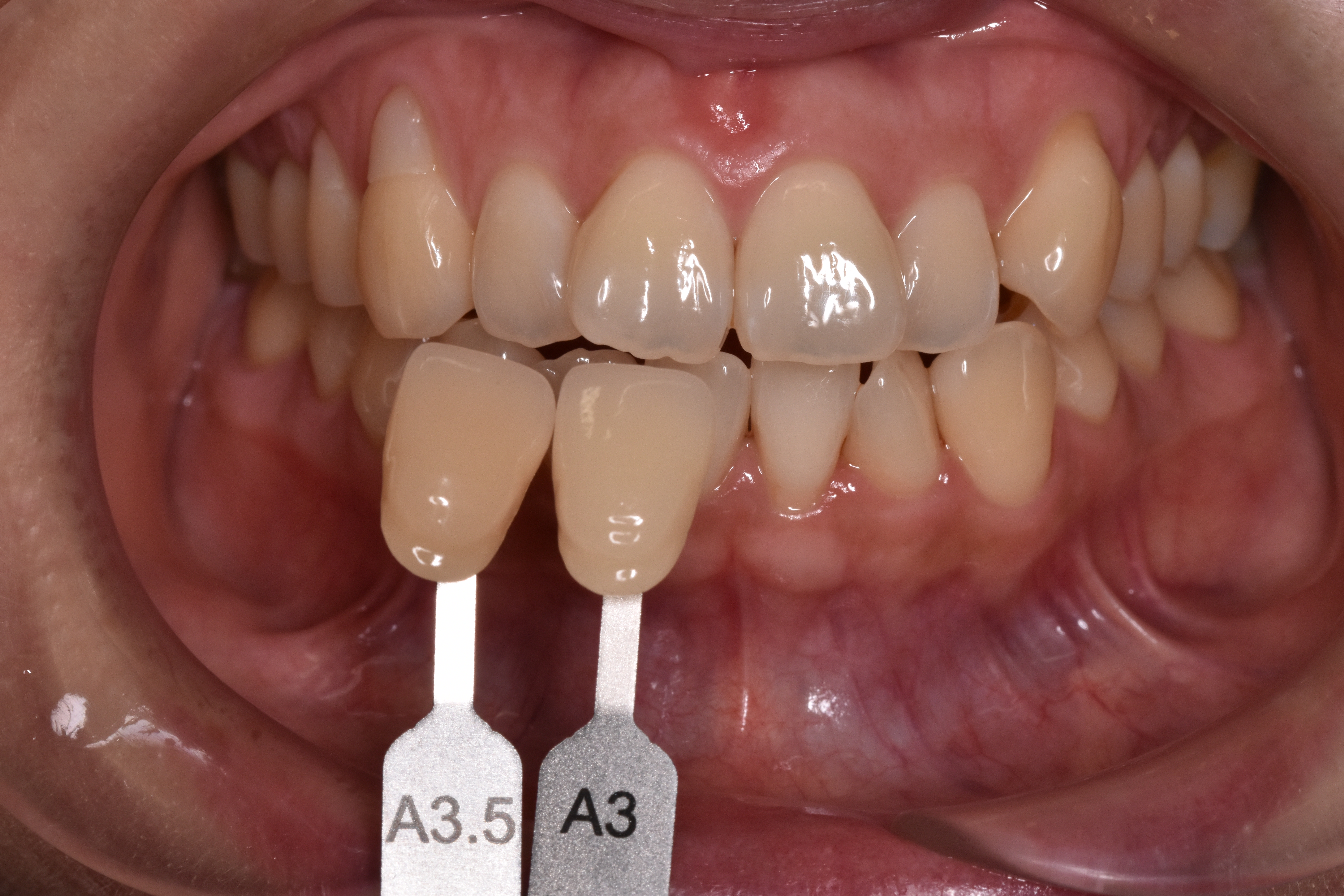 デュアルホワイトニング