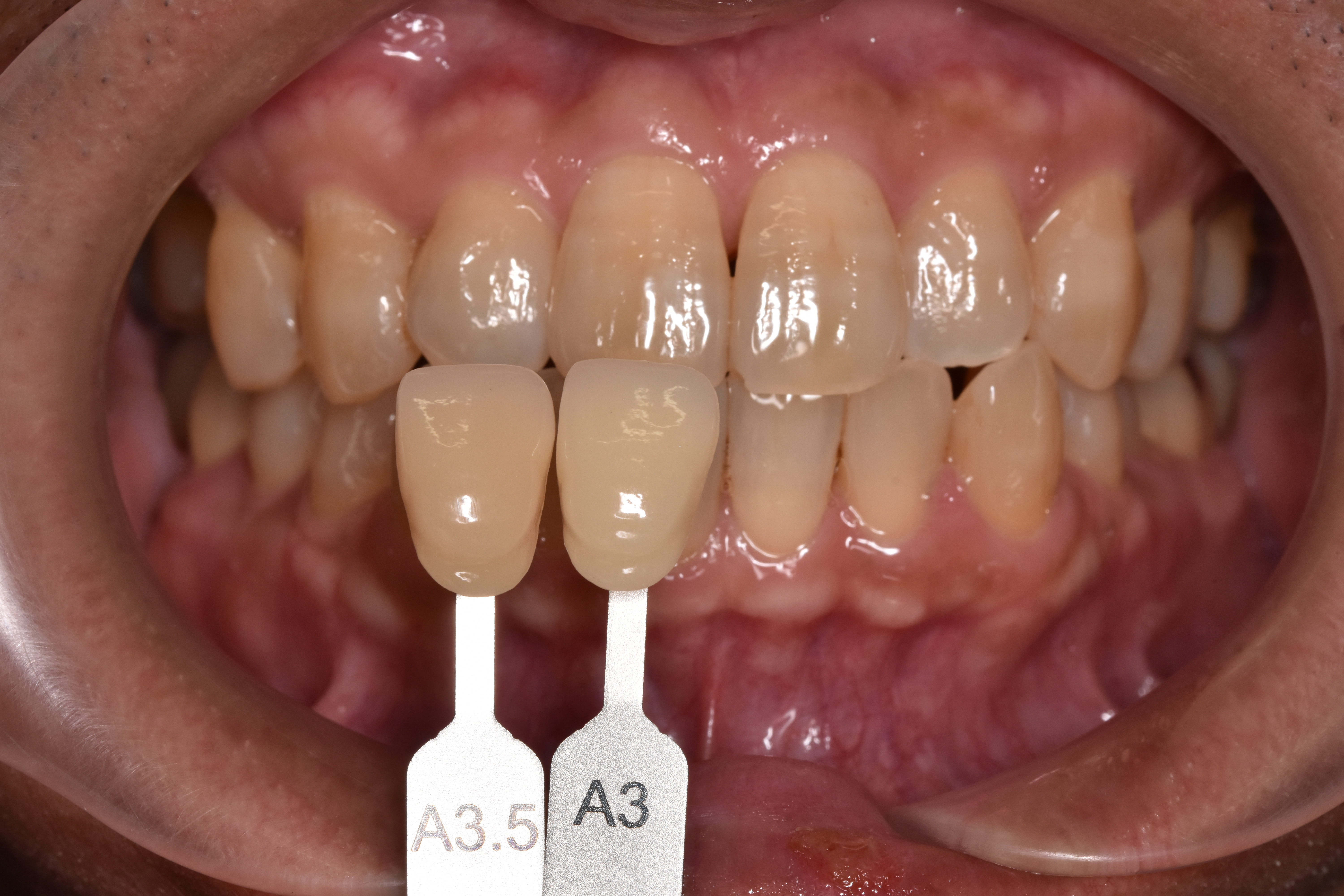 ホームホワイトニング