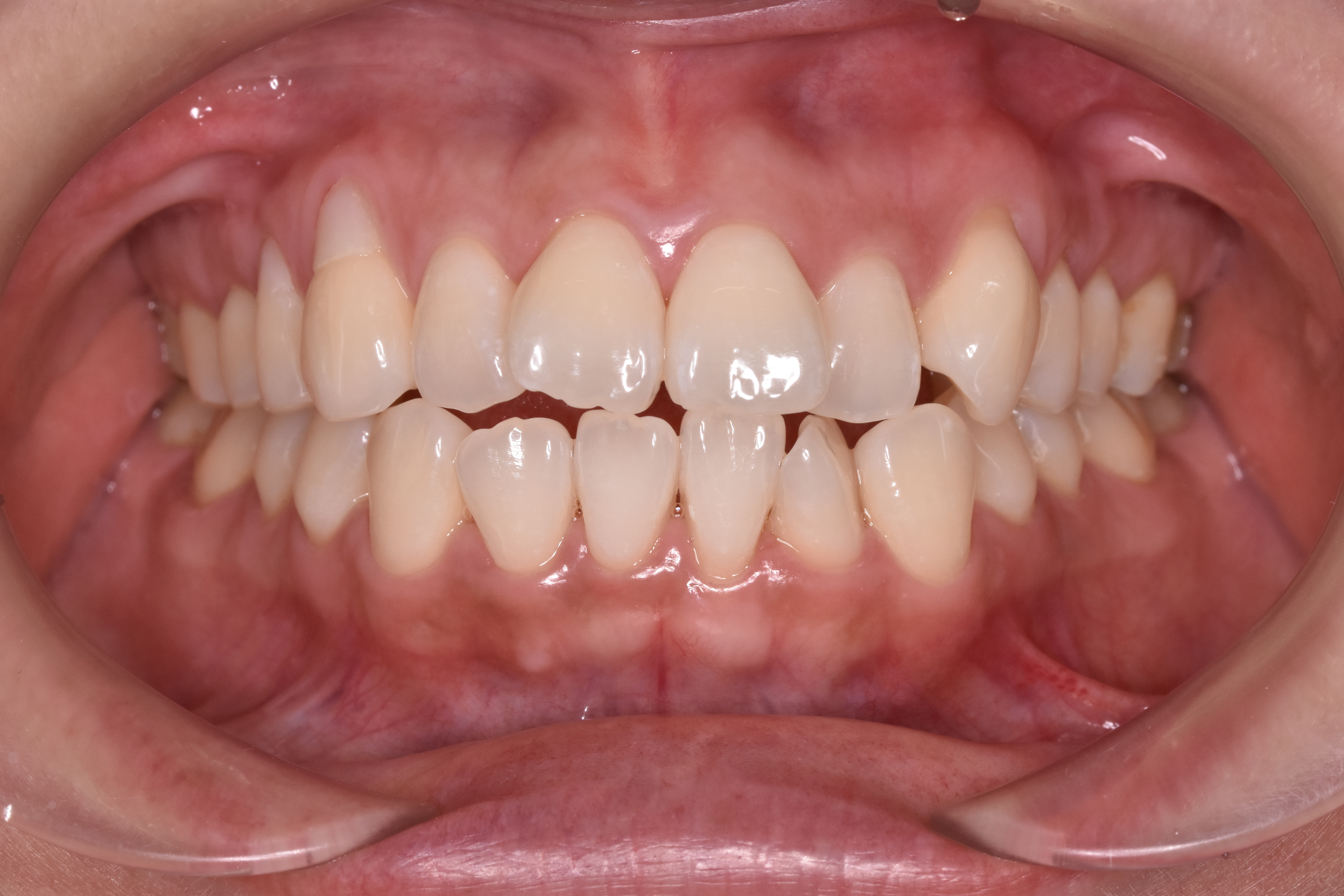 デュアルホワイトニング