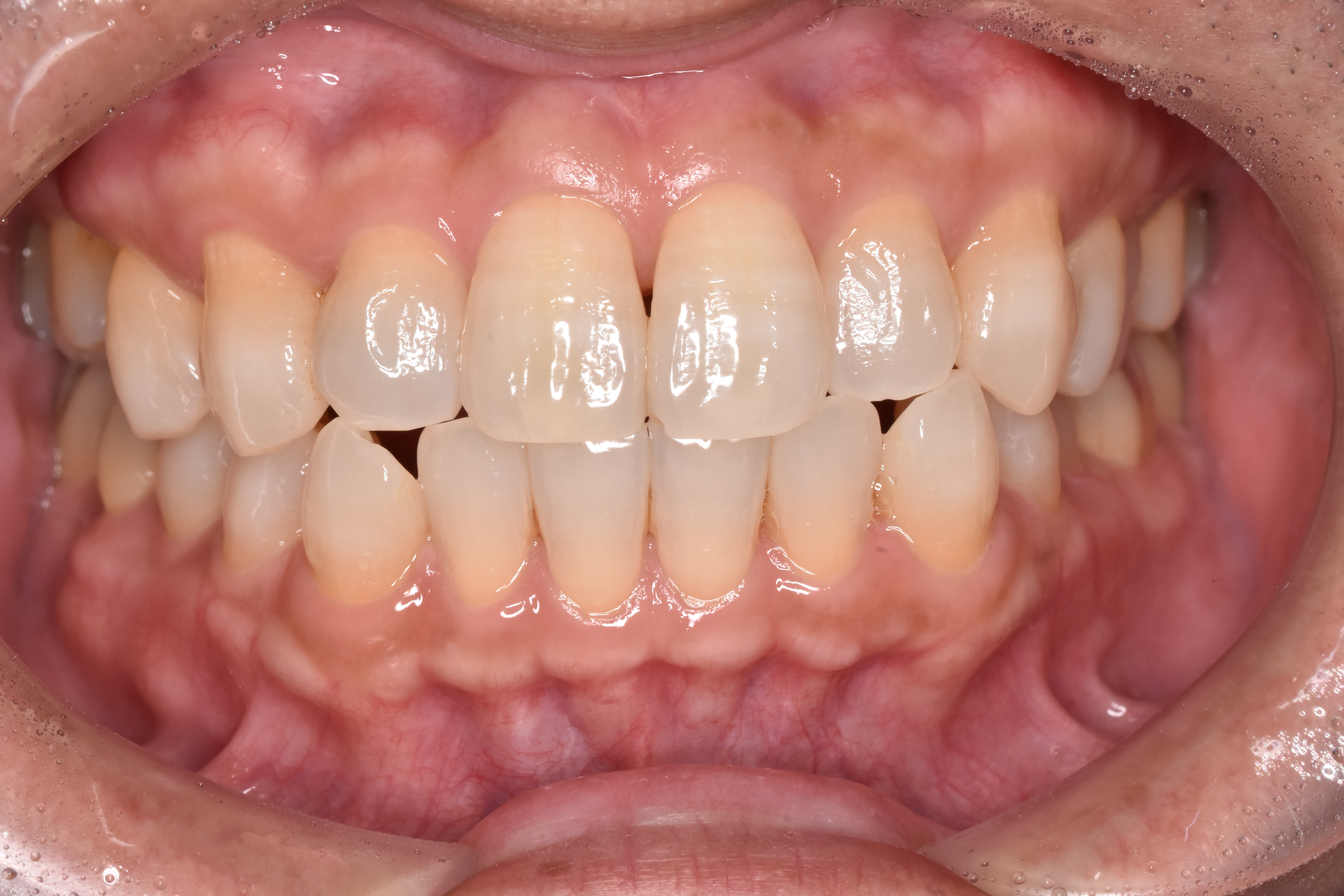 ホームホワイトニング