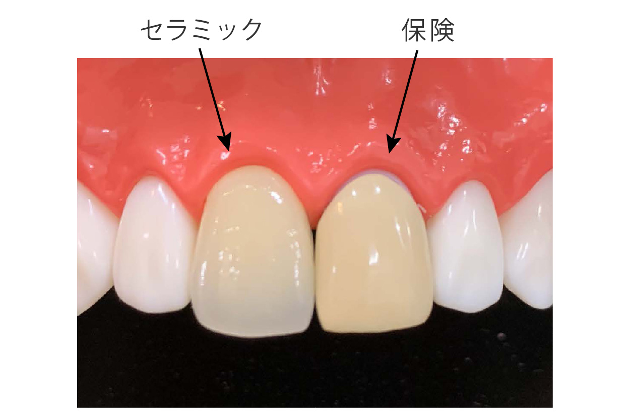 セラミックと保険